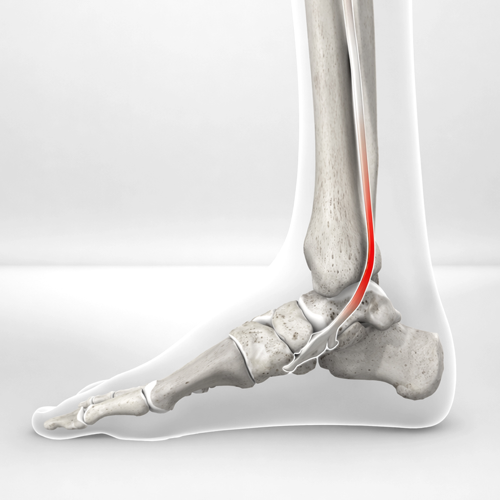 Posterior Tibial Tendinitis / Dysfunction featured image