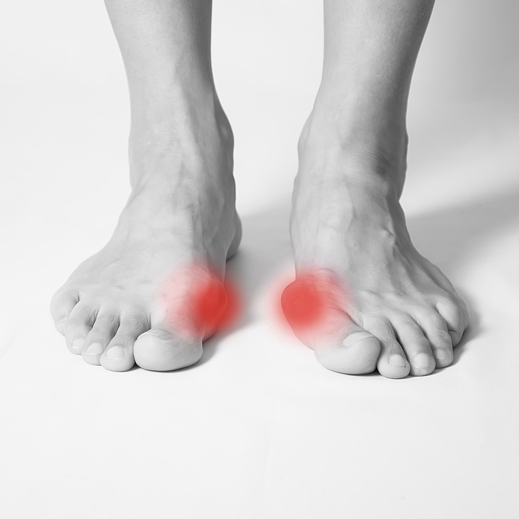 Hallux Valgus (Bunion) featured image