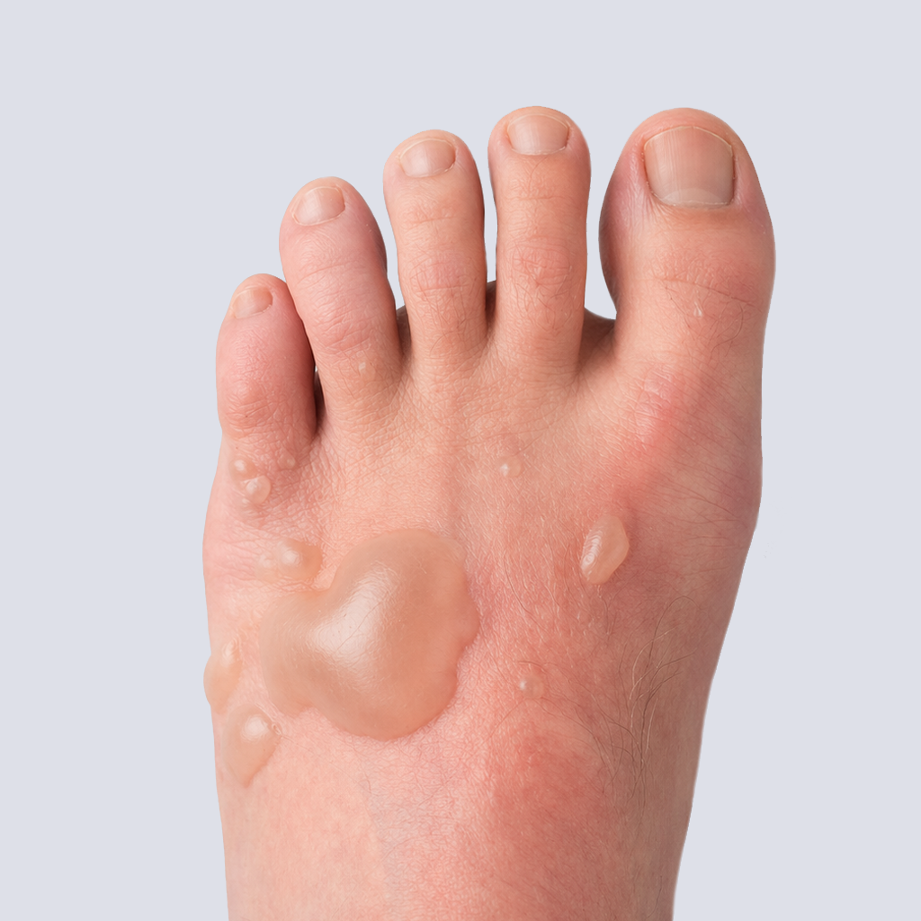 Blisters featured image