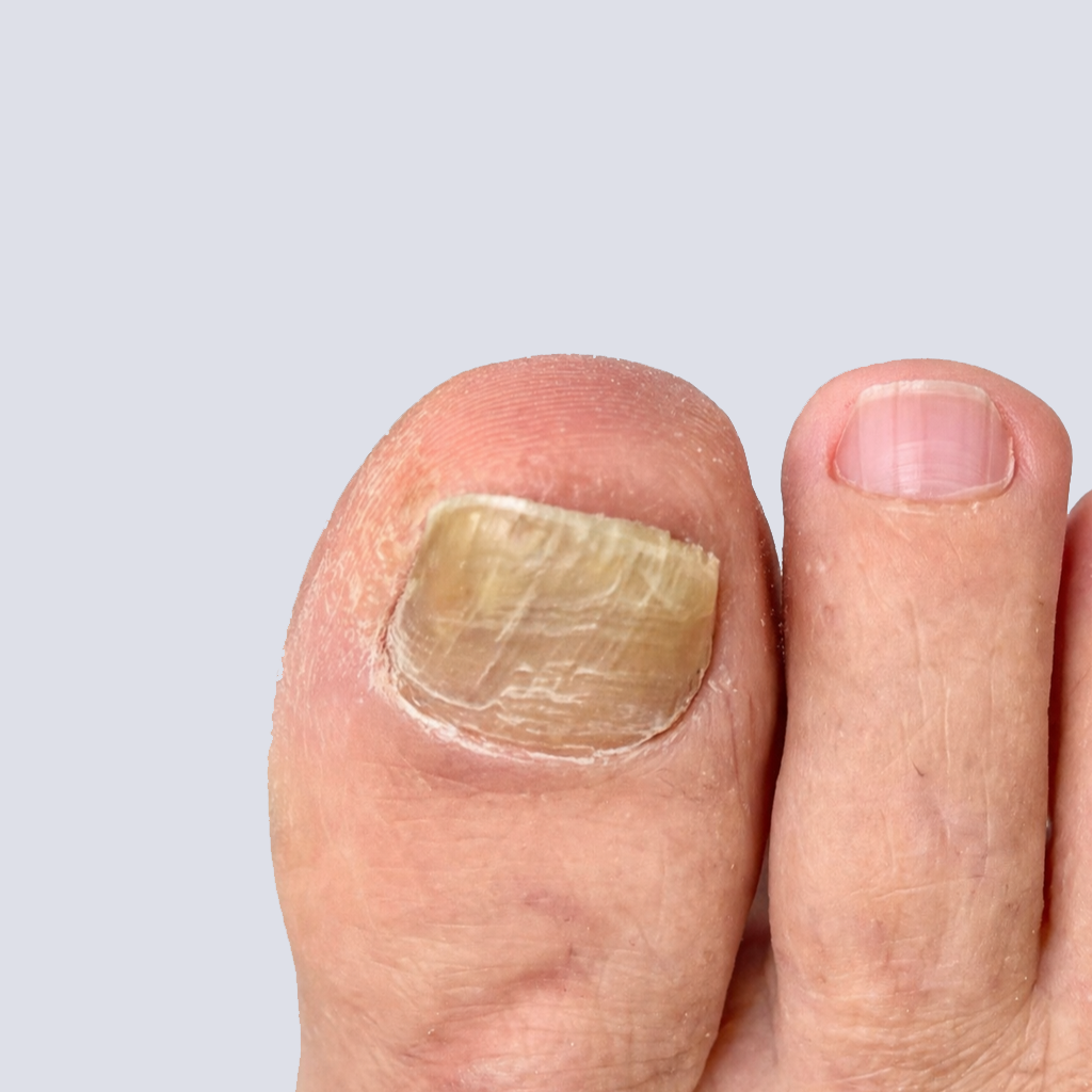 Thick Toenails featured image